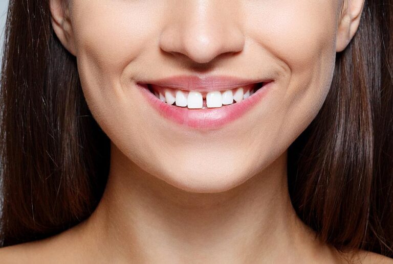 Teeth Gap Bands – Causes, Considerations, and 3 Proofs to that It’s Safe to Use